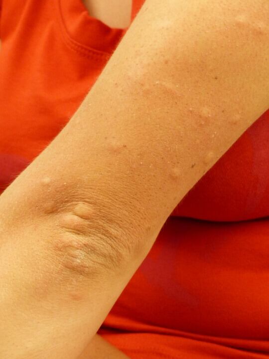 Urticaria o picazón. (Foto: Pixabay)