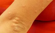 Urticaria o picazón. (Foto: Pixabay)